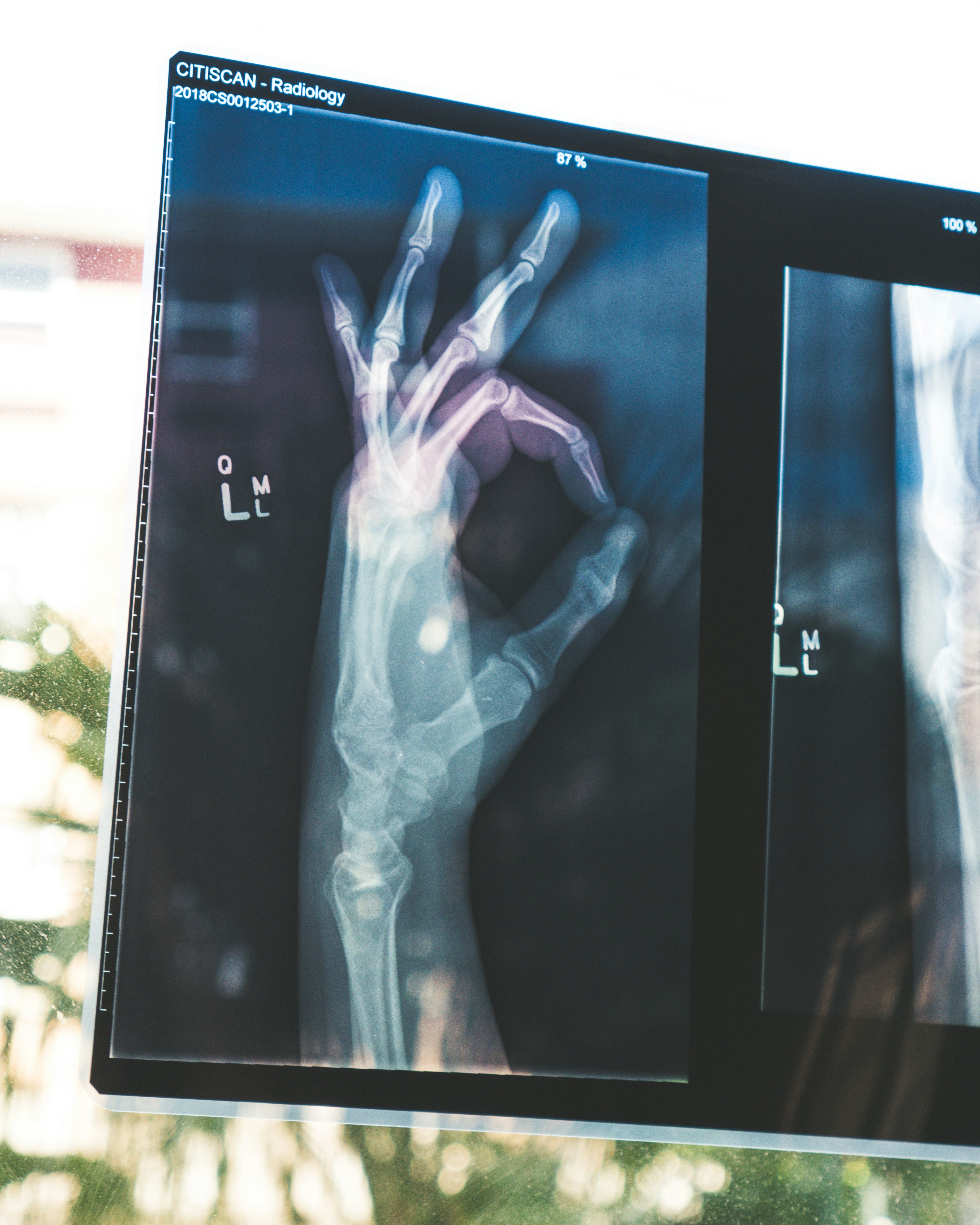 X-ray of a human hand showing bone structure